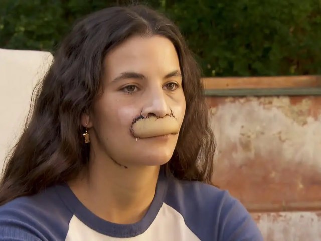 ピットブルに上唇をかみちぎられてしまった22歳の女性モデル